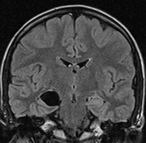 Choroidal Fissure Cyst MRI