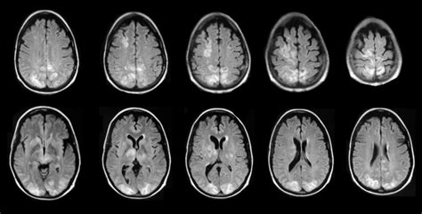 Hypertensive Encephalopathy