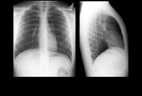 A 61-Year-Old Woman with Radiating Abdominal Pain: Case Presentation