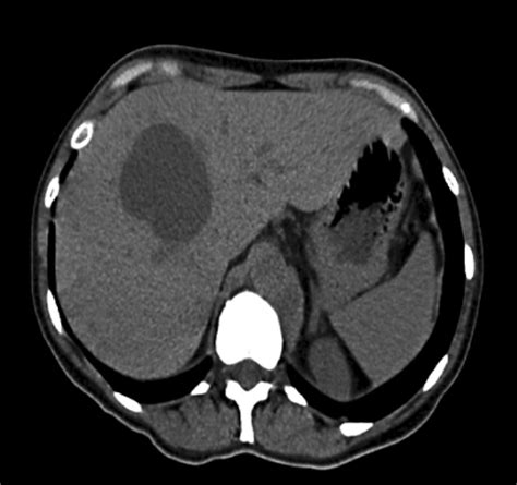 Figure 1:Adult Mesenchymal Hamartoma of the Liver: Case Report and ...