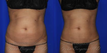 What is Lipo 360°? - Houston Lipo Center