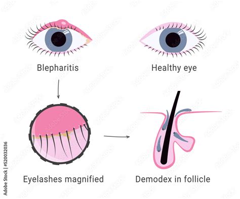 Demodex infection causing blepharitis. Eyelash mites microscope view. Demodex mite in hair ...