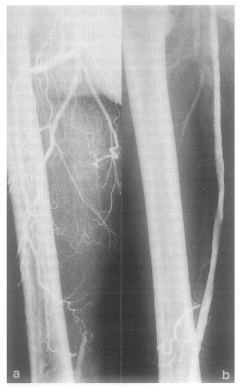 Showing a 25 cm superficial femoral artery occlusion before (a) and... | Download Scientific Diagram