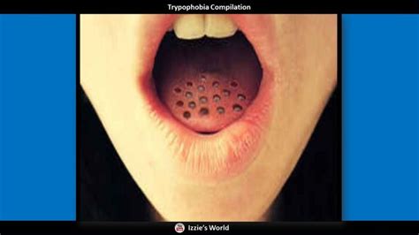 Trypophobia Skin Disease Test