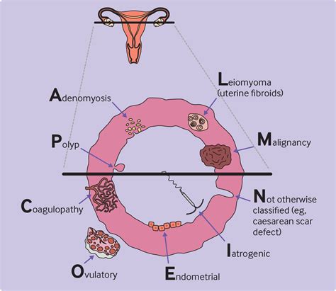 Investigating abnormal uterine bleeding in reproductive aged women | The BMJ