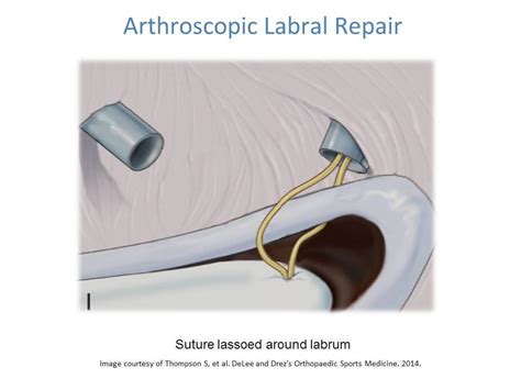 Shoulder Labral Tear- Labral Repair and Rehabilitation | Ashvin K Dewan, MD