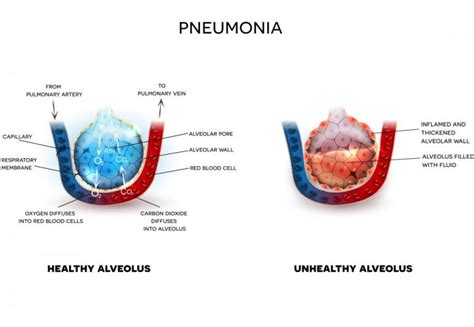 Chlamydia Pneumoniae | symptoms, types, diagnosis, treatment