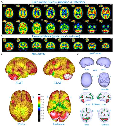 Bipolar Disorder Brain