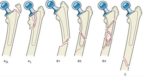 THA Periprosthetic Fracture - Recon - Orthobullets