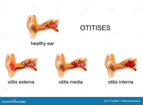 Orecchio Otite Media, Interno, Esterna, Illustrazione Vettoriale - Illustrazione di anatomico ...