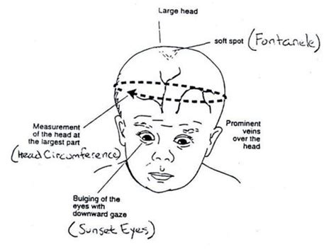 increased ICP | Pathophysiology/Diseases | Pinterest | Nclex, Nursing ...