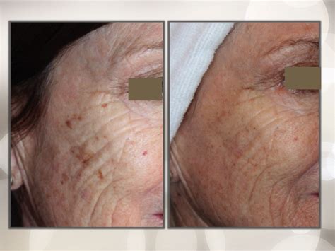 KTP Laser – UCosmetic