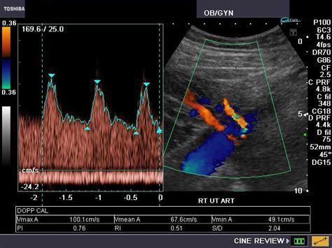 Ultrasound and Color Doppler videos: Color Doppler imaging of the ...