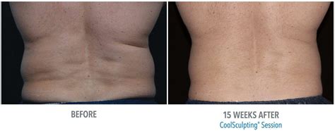 3 Things You Need to Know About CoolSculpting Side Effects | Dermacare HR