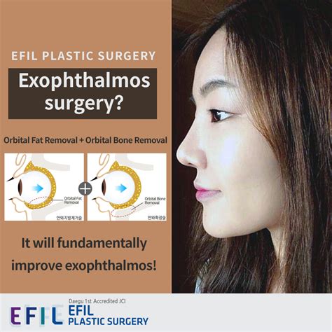 EFIL Bulging Eyes Plastic Surgery JCI: Exophthalmos surgery, protruded eyeball treatment ...