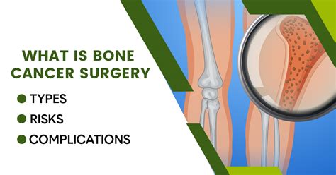 What is Bone Cancer Surgery, Types and Risks and Complications