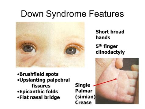 Upslanting Palpebral Fissure