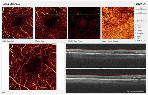 OCT angiography