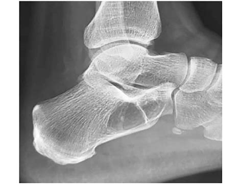 Plain x-ray of the left heel showing a well-defined lytic lesion in the... | Download Scientific ...