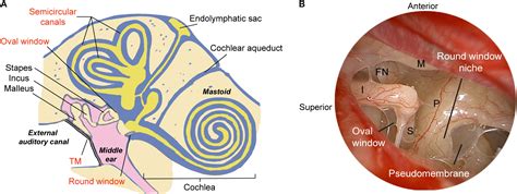 Frontiers | Gene Therapy for Human Sensorineural Hearing Loss