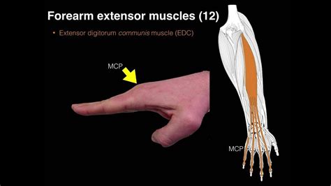 Forearm extensor muscles | Extensor muscles, Muscle knots, Forearm muscles