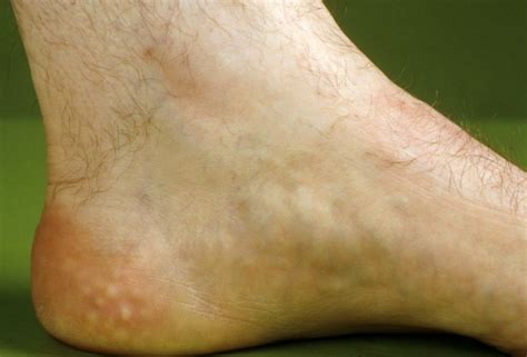 Bilateral Piezogenic Papules Of The Heel - Painful nodules and plaques ...