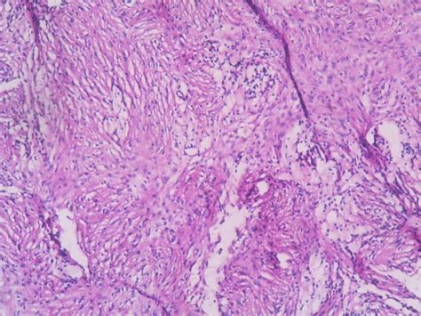 Fibrous histiocytoma of bone – Histopathology.guru