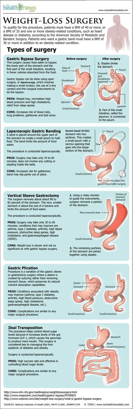 Infographic: Types of Weight Loss Surgery - HealthStatus