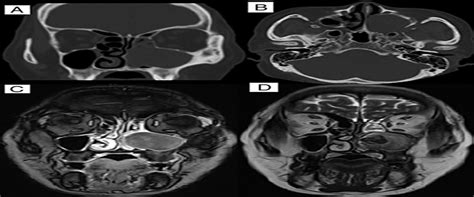 Maxillary Sinus Mucocele With Fungal Ball : Journal of Craniofacial Surgery