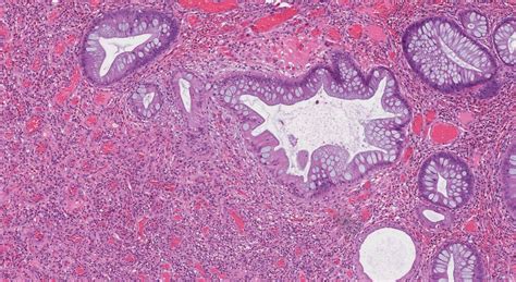 Inflammatory type polyp of the colon | Atlas of Pathology