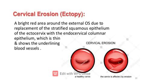 SOLUTION: Cervical erosion - Studypool