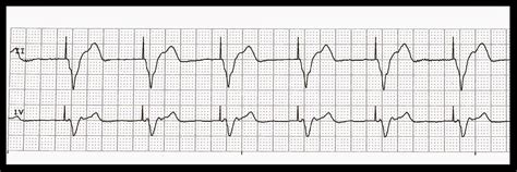 Practice EKG Strips 415