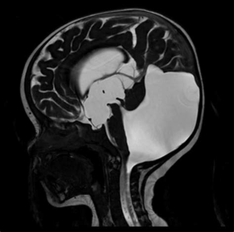 Dandy-Walker malformation | Radiology Case | Radiopaedia.org | Radiology, Medical wallpaper ...