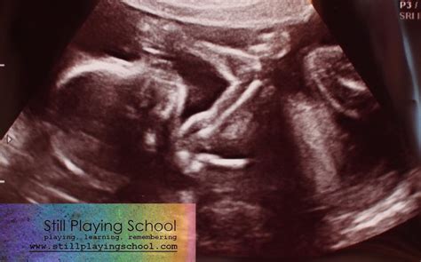 20 Week Anatomy Scan Ultrasound