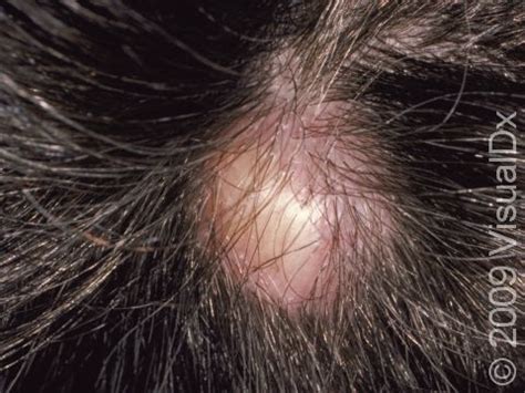 Pilar Cyst Condition, Treatments and Pictures for Adults - Skinsight