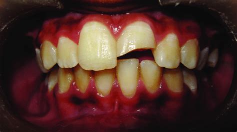 Ellis class III fracture of the maxillary left central incisor | Download Scientific Diagram