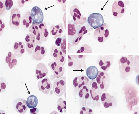 Naegleria fowleri amoeba or brain eating amoeba infection and treatment