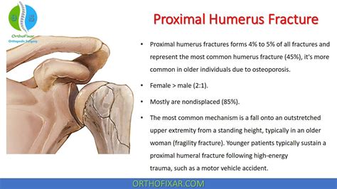 Proximal Humerus Fracture • Easy Explained | OrthoFixar 2024