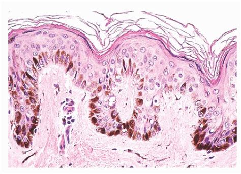 Melanocytic Lesions | Basicmedical Key