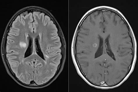 Active MS plaques on DWI