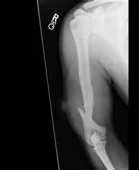 Humerus Fracture - Causes, Symptoms, and Treatment