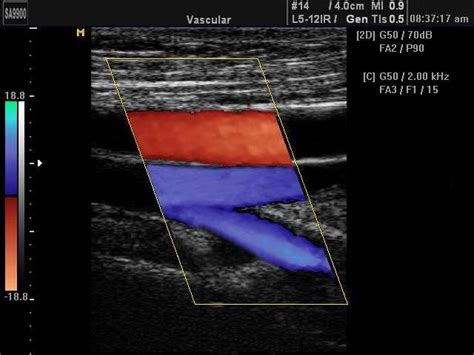 Superficial femoral artery, common femoral vein bifurcation, color doppler | Radiology imaging ...