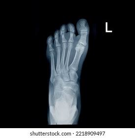 Xray Image Top Left Foot Adult Stock Photo 2218909497 | Shutterstock