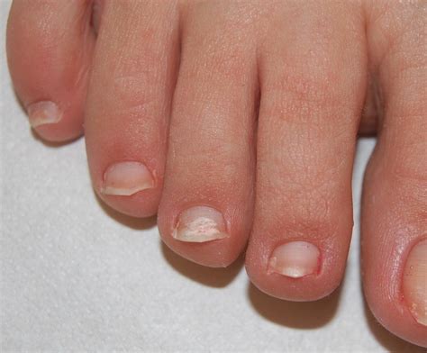 White superficial onychomycosis (WSO): white opaque friable patches of... | Download Scientific ...