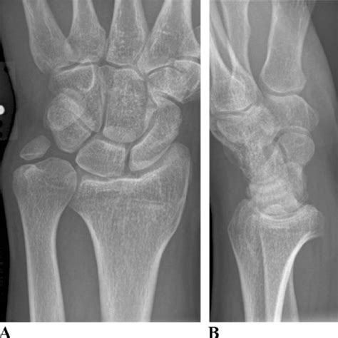 Ulnar impaction syndrome after a malunited distal radius fracture with... | Download Scientific ...