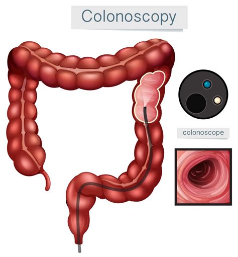 What is a Colonoscopy and Why Do It? - Digestive Diseases Associates of ...