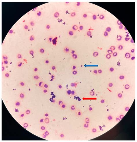 Microorganisms | Free Full-Text | Acute Pyelonephritis with Bacteremia in an 89-Year-Old Woman ...