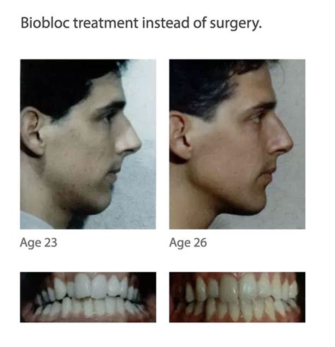 adult (mid-20s) biobloc orthotropics