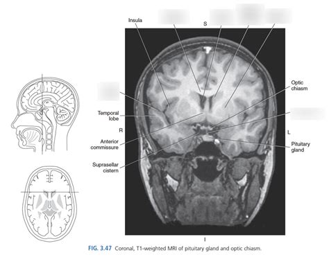 Coronal MRI fo Brain Diagram | Quizlet