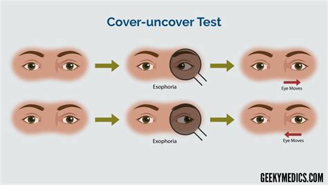 Strabismus | Exotropia - Esotropia | Cover test | Geeky Medics